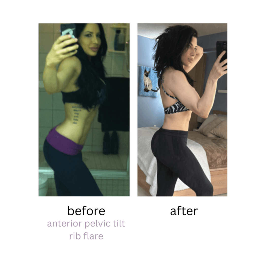 fix rib flare and anterior pelvic tilt program